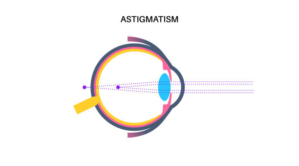 Astigmatism